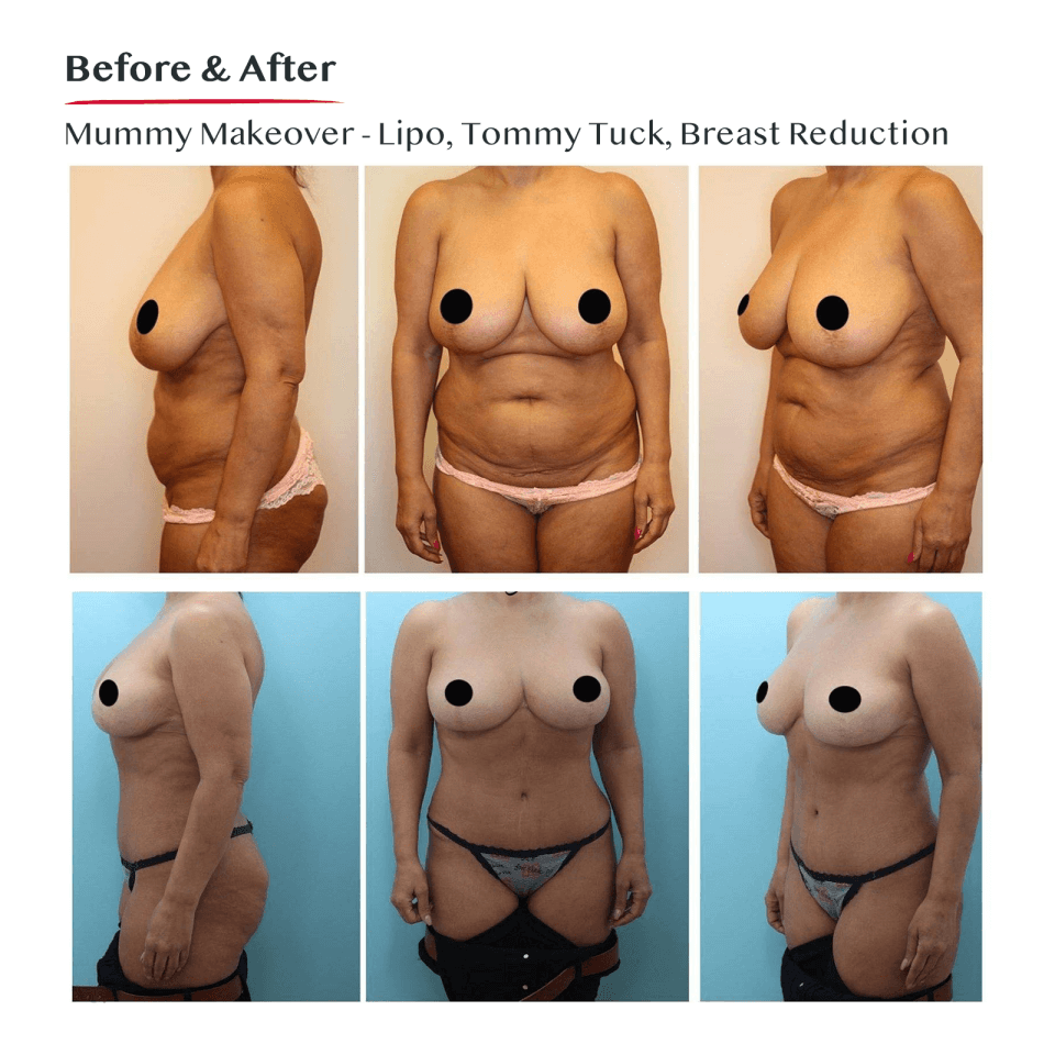 Breast reduction Information